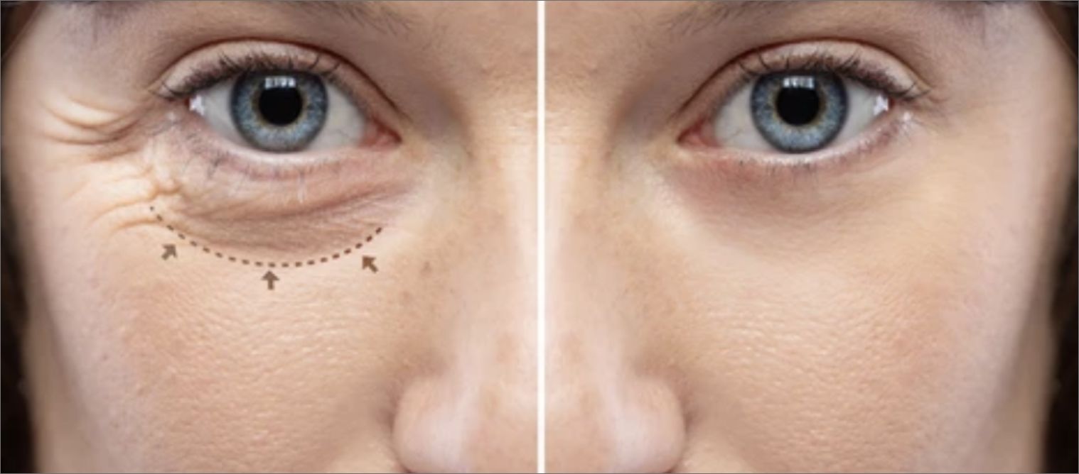 BLEFAROPLASTIA