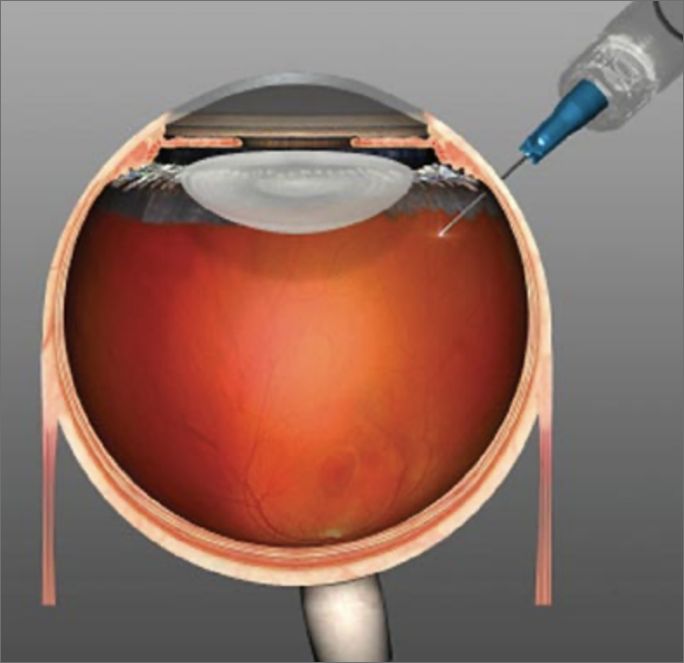 INYECCIONES INTRAVITREAS