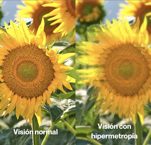HIPERMETROPIA