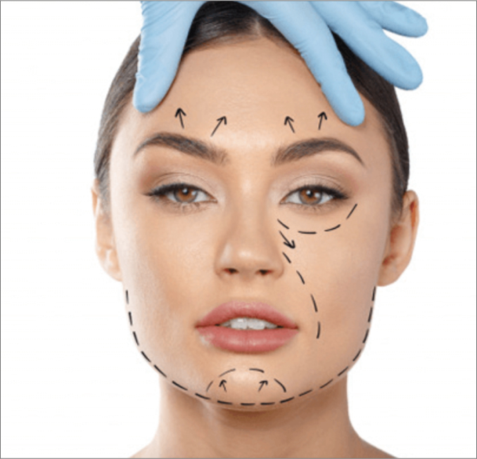 MESOTERAPIA