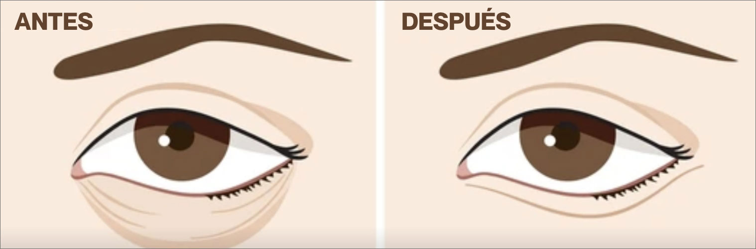 BLEFAROPLASTIA