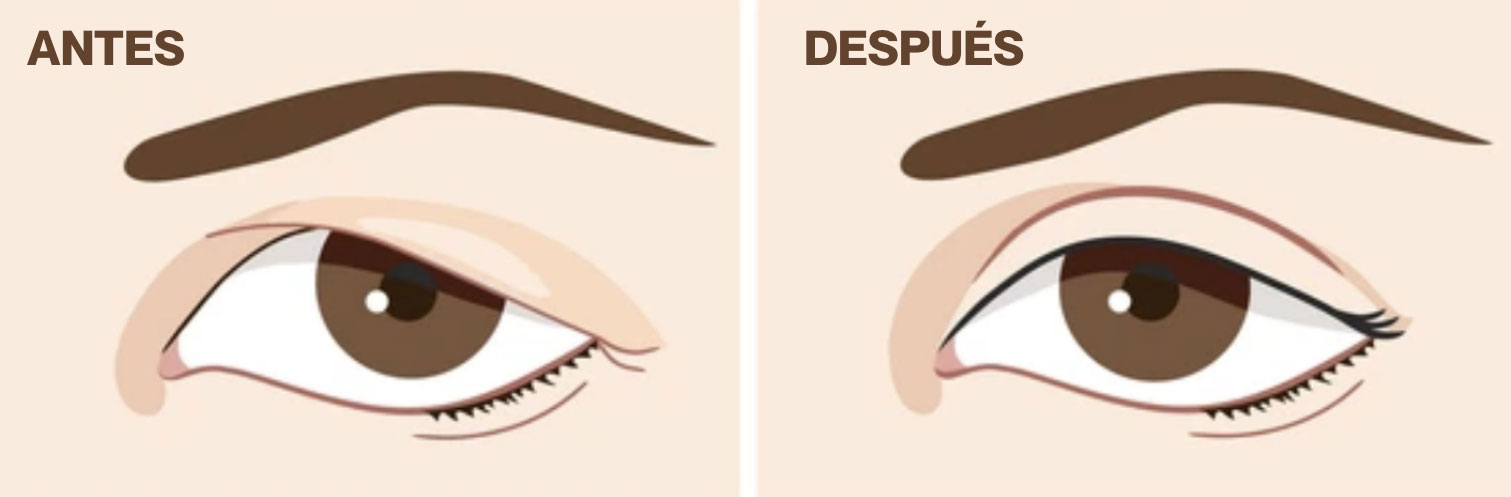 BLEFAROPLASTIA